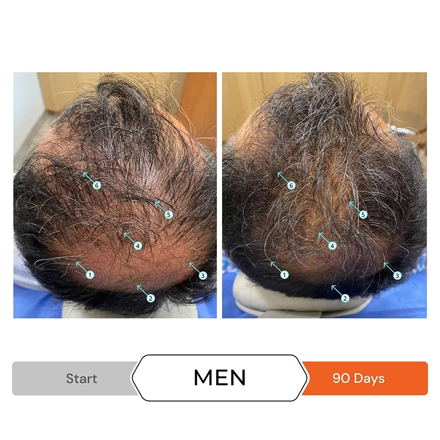 Revita Shampoo w/Biotin, Caffeine and Hair Growth StimuLatitudeing Ingredients, Helps Block DHT w/DNC-N Nanoxidil 5% Hair Regrowth Treatment