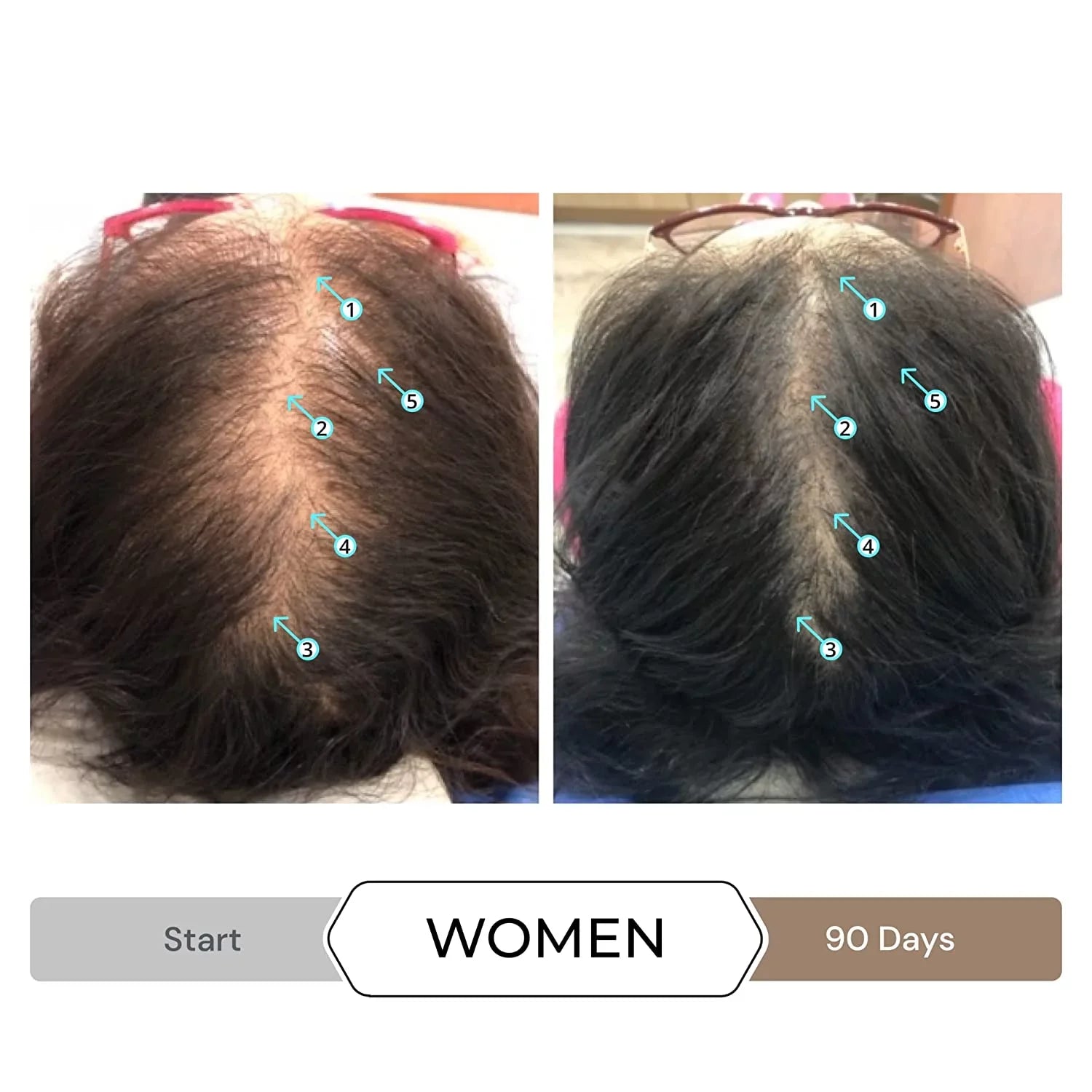 Revita Shampoo w/Biotin, Caffeine and Hair Growth StimuLatitudeing Ingredients, Helps Block DHT w/DNC-N Nanoxidil 5% Hair Regrowth Treatment