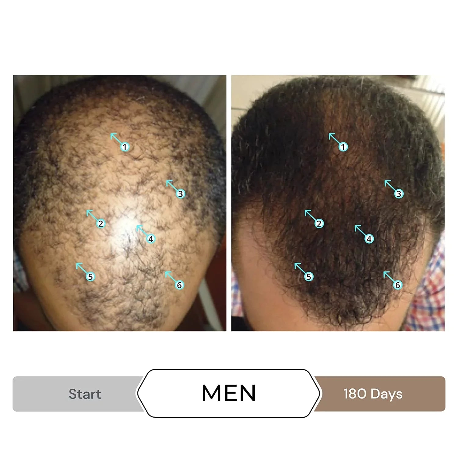 Revita Shampoo w/Biotin, Caffeine and Hair Growth StimuLatitudeing Ingredients, Helps Block DHT w/DNC-N Nanoxidil 5% Hair Regrowth Treatment